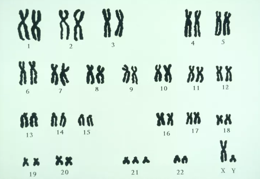 Trisomy là gì?