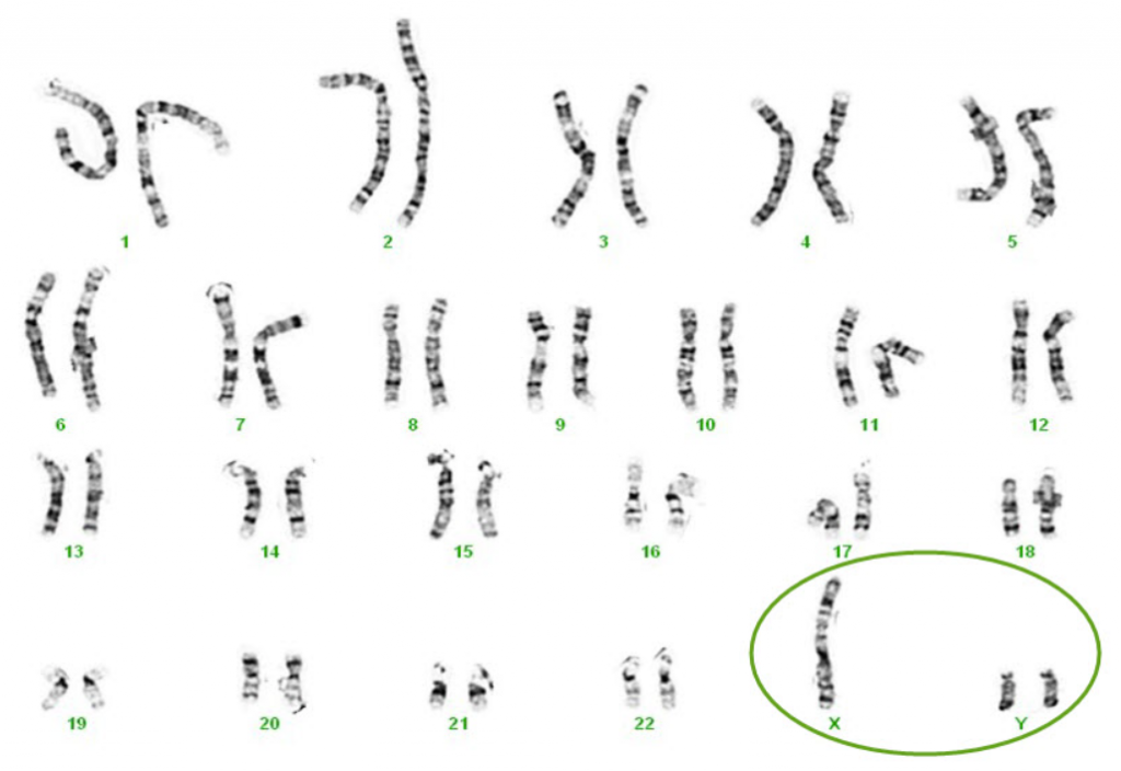 Hội chứng Jacobs – 47,XYY